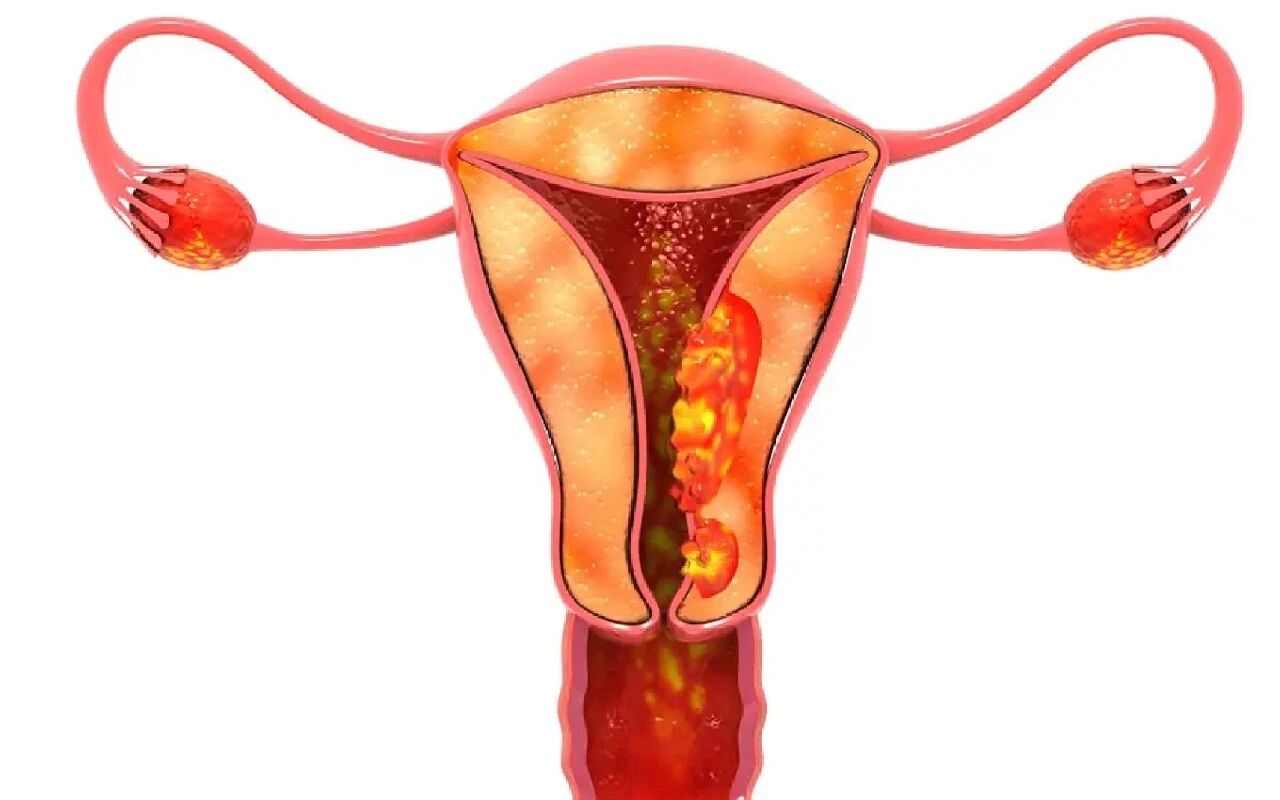 宫颈上皮内瘤是什么情况 宫颈上皮内病变是指宫颈病变可分为低级别