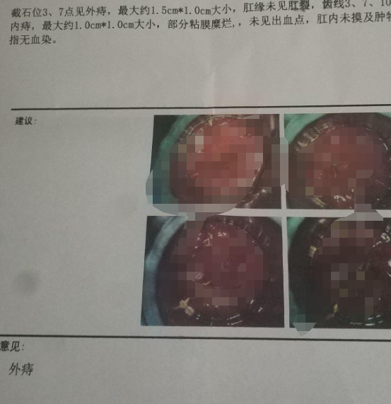 关于北京市肛肠医院检查陪护加挂号复杂病情综合分析,治疗方向更明确的信息 关于北京市肛肠医院检查陪护加挂号复杂病情综合分析,治疗方向更明确的信息