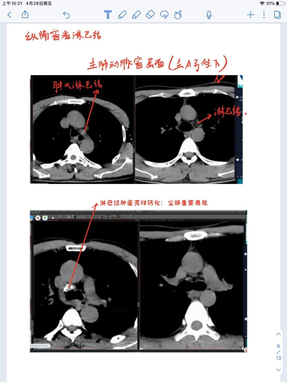 尘肺 影像学表现*天天师兄读片班 尘肺诊断* 双肺多发,以上肺分布为主