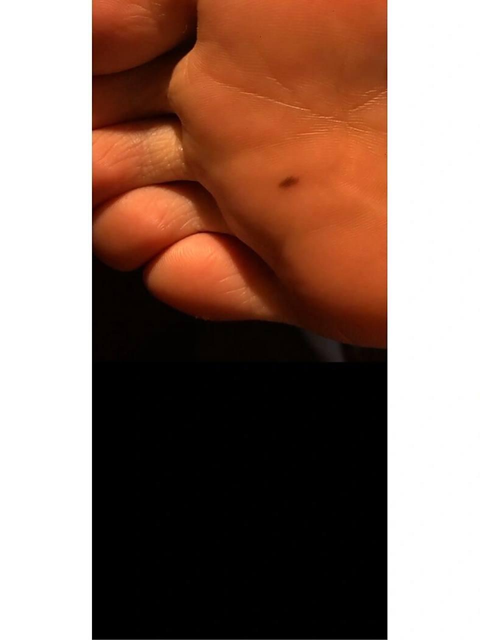 纪念一下我逝去的脚底黑痣 终于去了我的一块心病