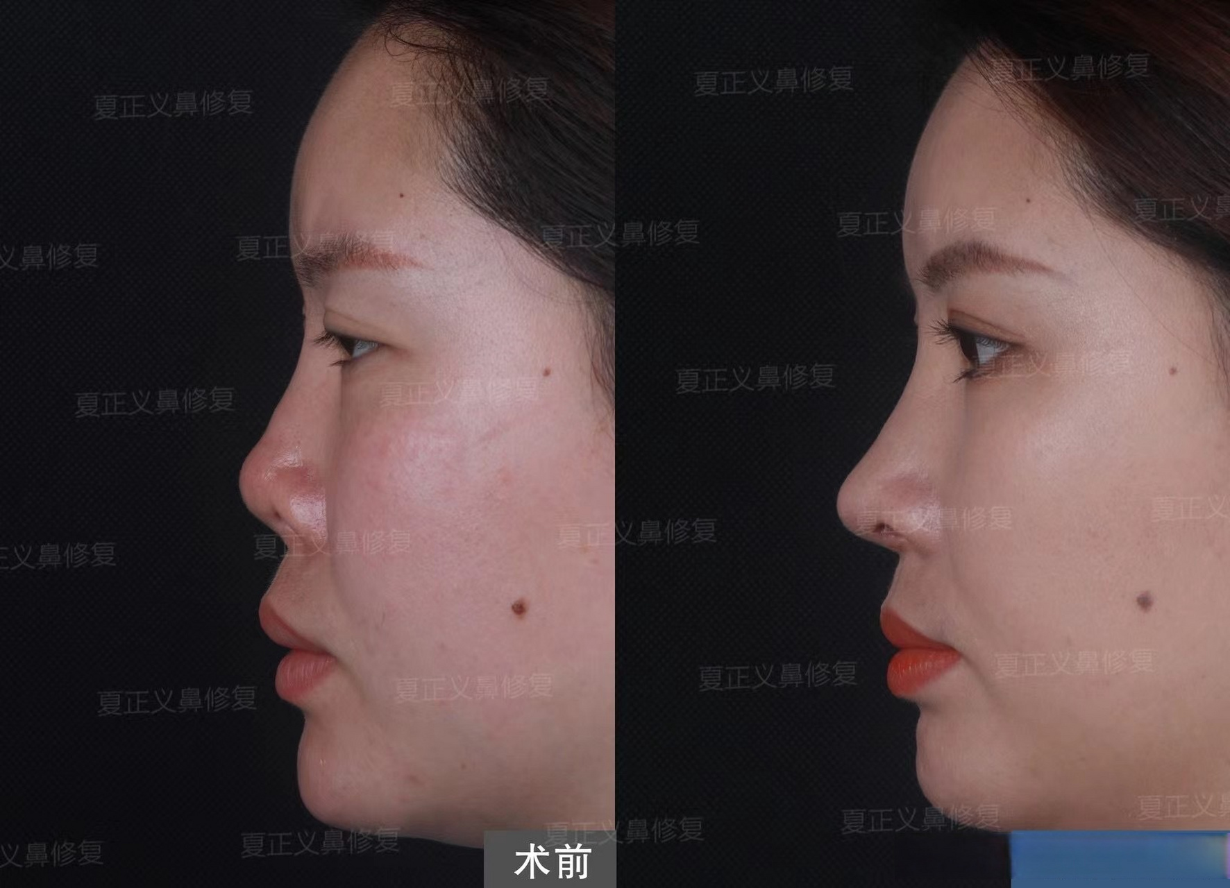 【挛缩鼻修复】 正面漏鼻孔,朝天短鼻,形态怪异,重新搭建鼻部结构