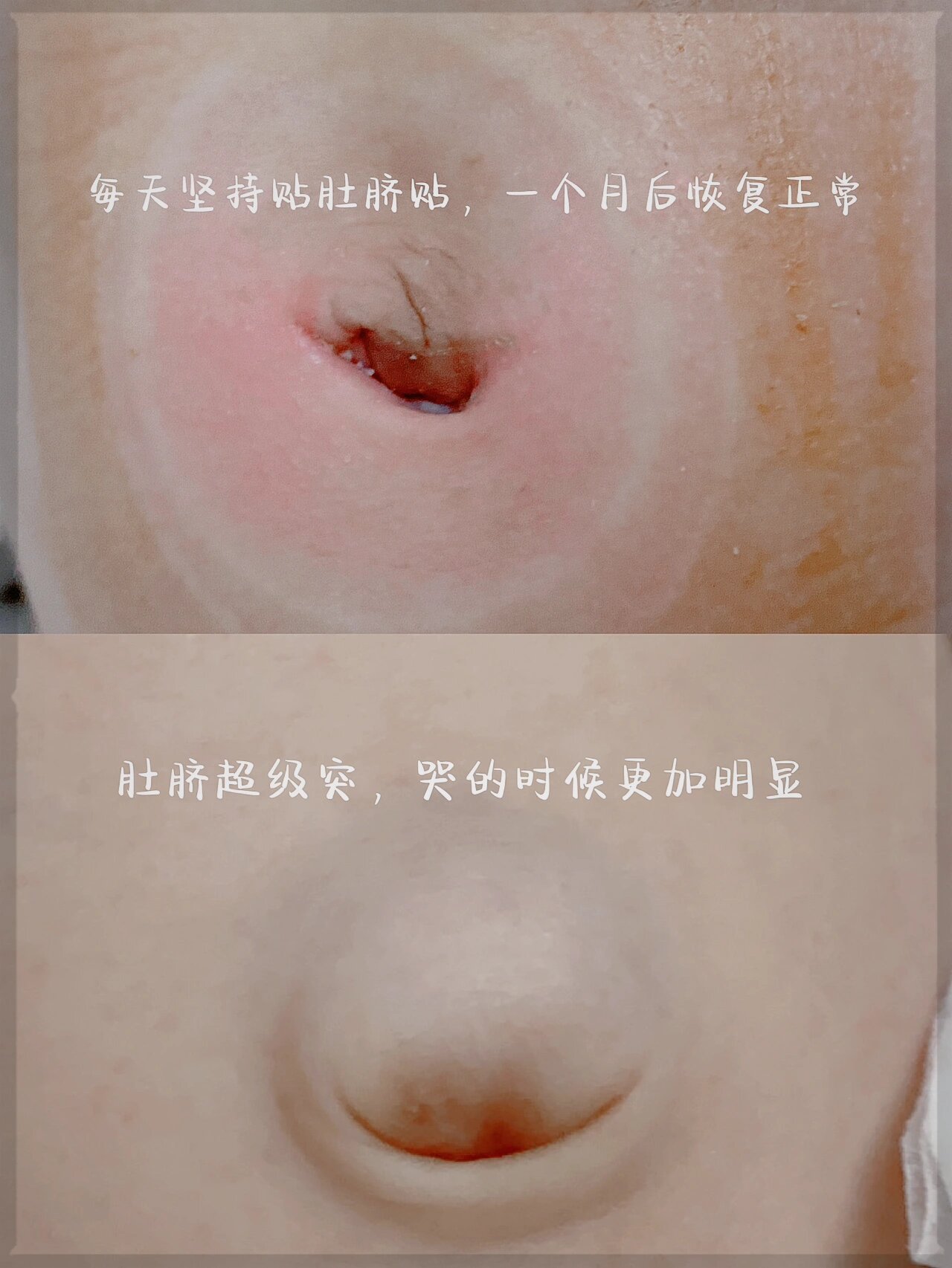 plog|宝宝脐疝不要怕 -脐疝俗称"气肚脐",是新生儿和婴儿时期常见的
