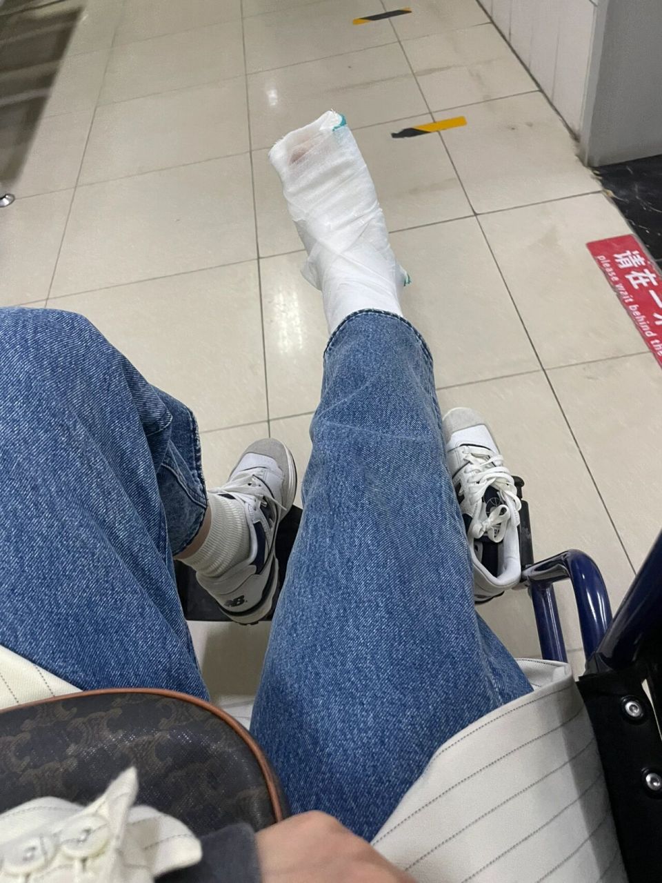脚趾(小拇指)骨折第四天 多久才能走路 真是倒霉起来喝凉水都塞牙缝