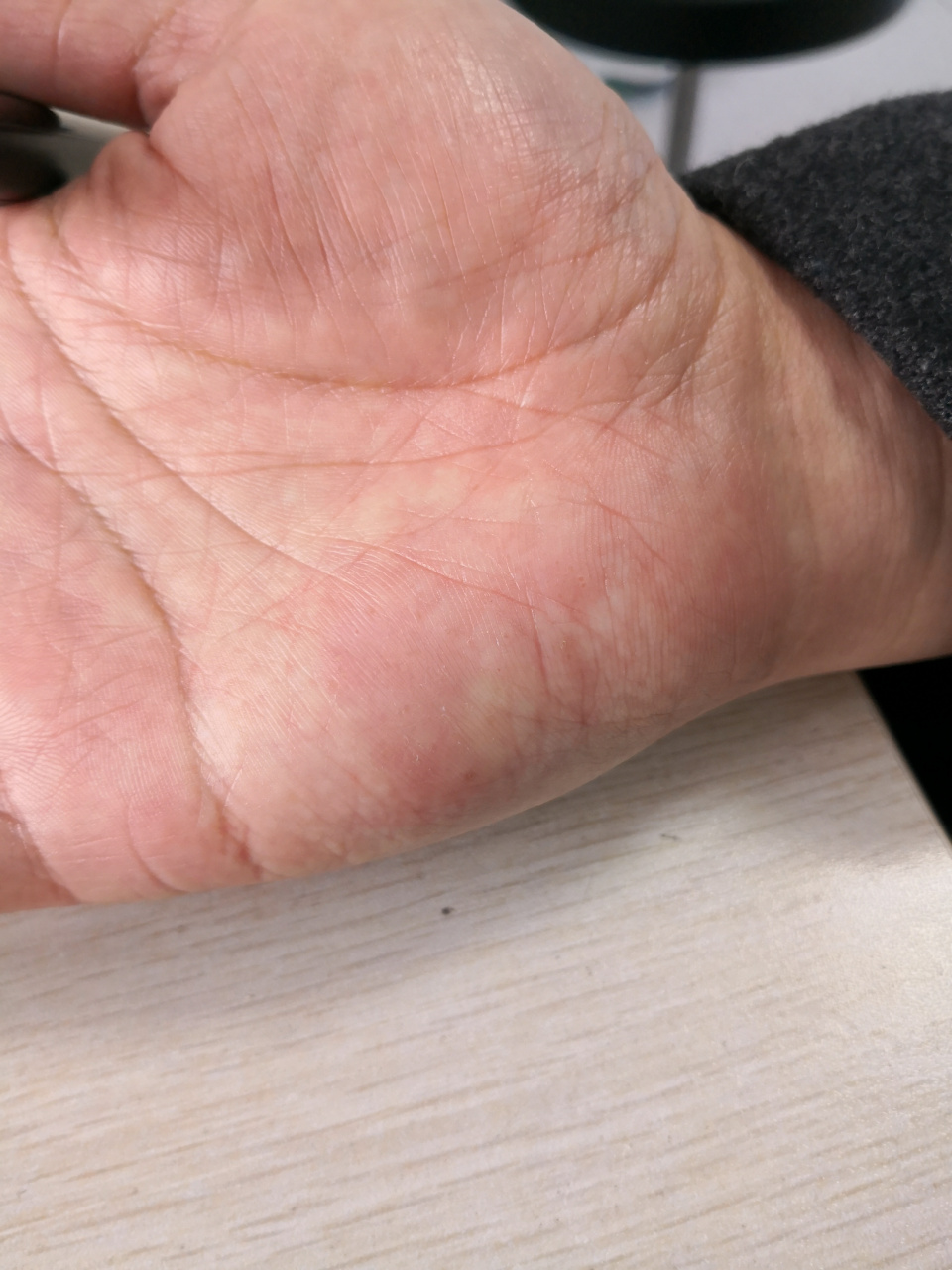 考虑手癣症状#真菌