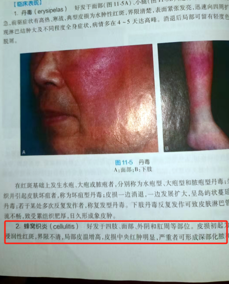 蜂窝组织炎早期症状有哪些?