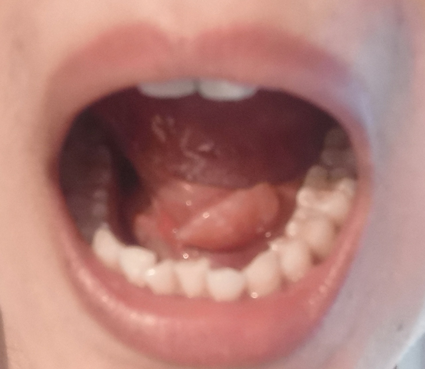 舌下腺囊肿自愈过程 一个月前发现舌头下长了个小包,没几天就变大成了