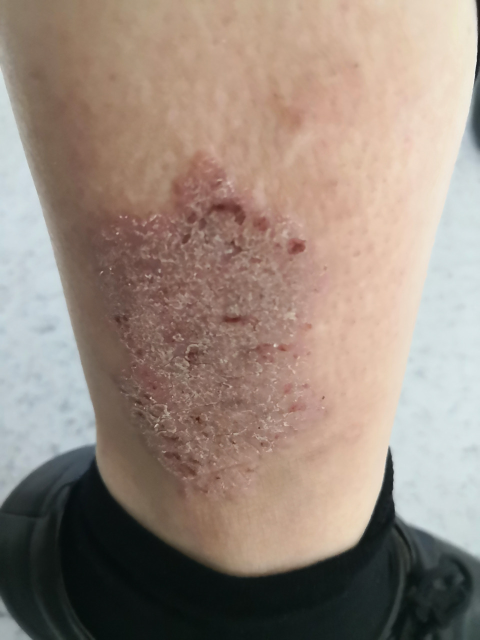 一侧小腿斑块状湿疹症状.#湿疹