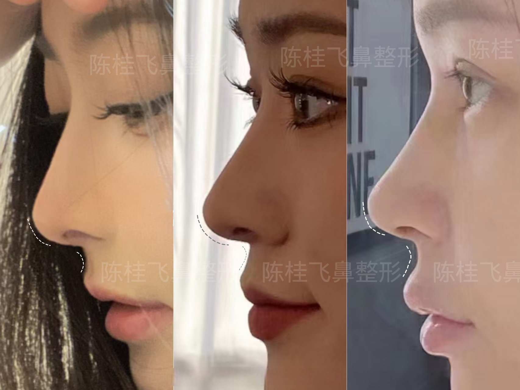 分享一组鼻模板[思考] #鼻模板##隆鼻模板