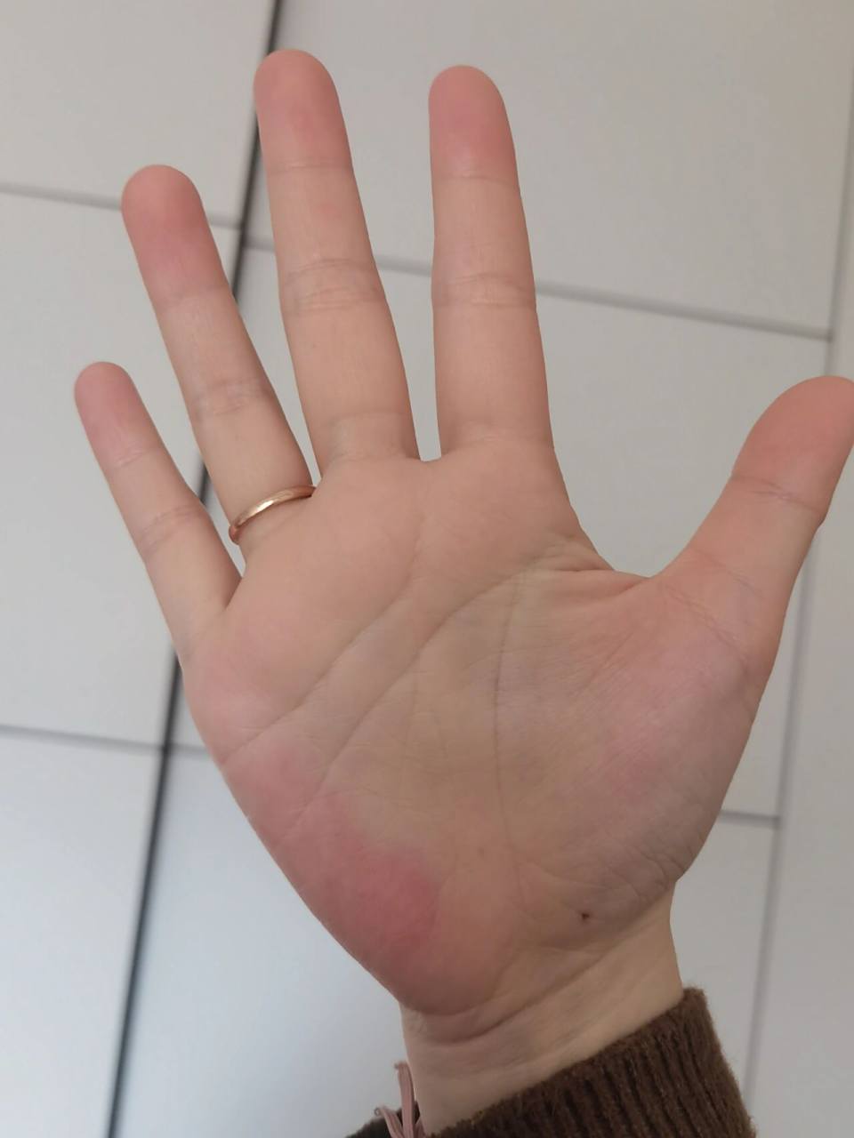 这是肝掌吗? 求解!