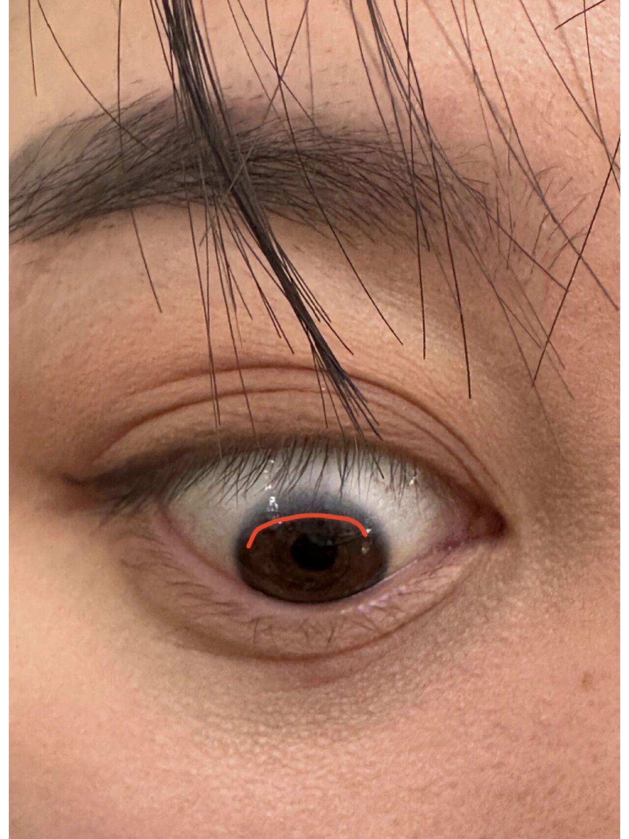 眼球不圆是怎么回事?