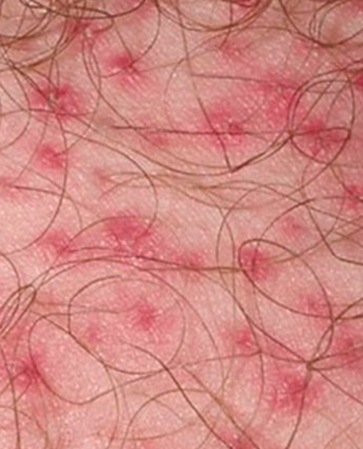 外阴毛囊炎多是因为不注意卫生,细菌