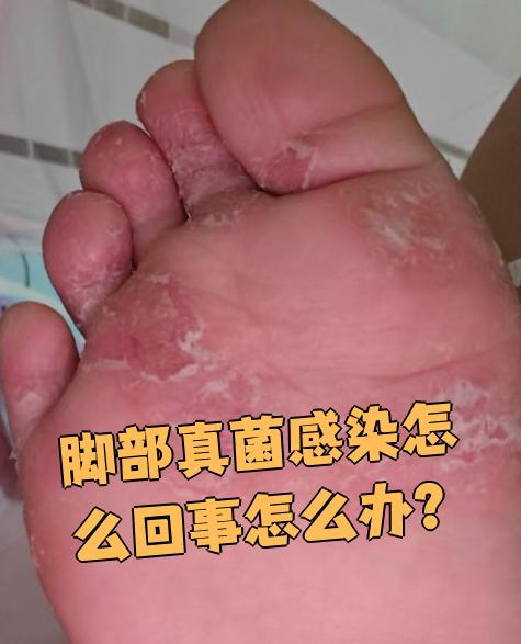根据症状不同,脚气