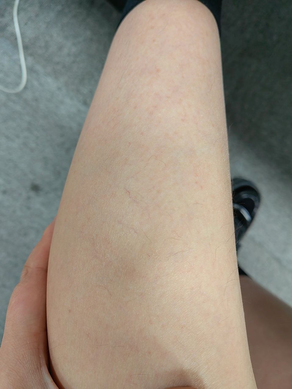 小腿上有坨淤青消不掉是怎么回事?