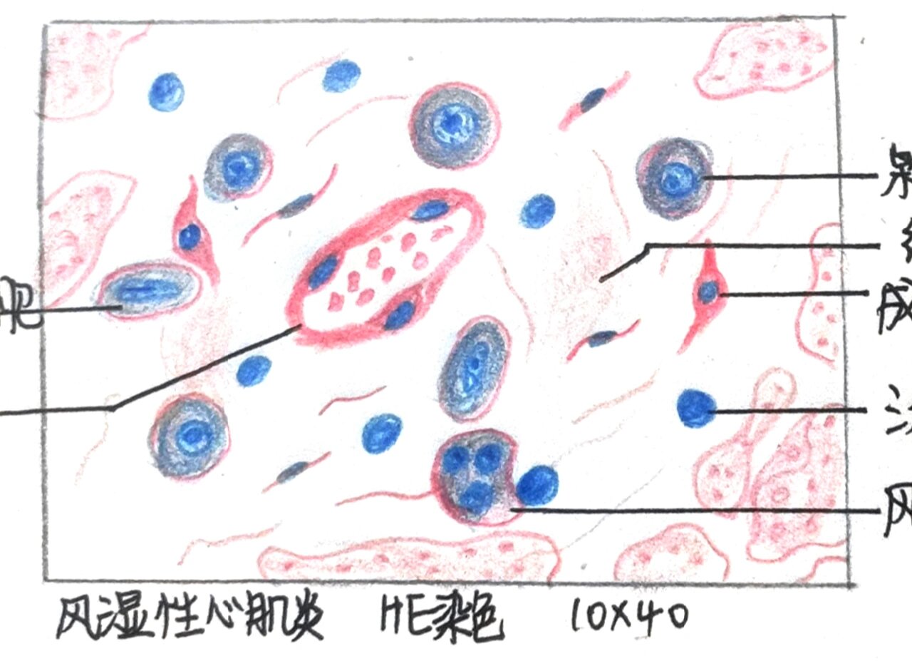 病理实验报告-风湿性心肌炎 红蓝铅笔手绘 心血管系统疾病 重点结构