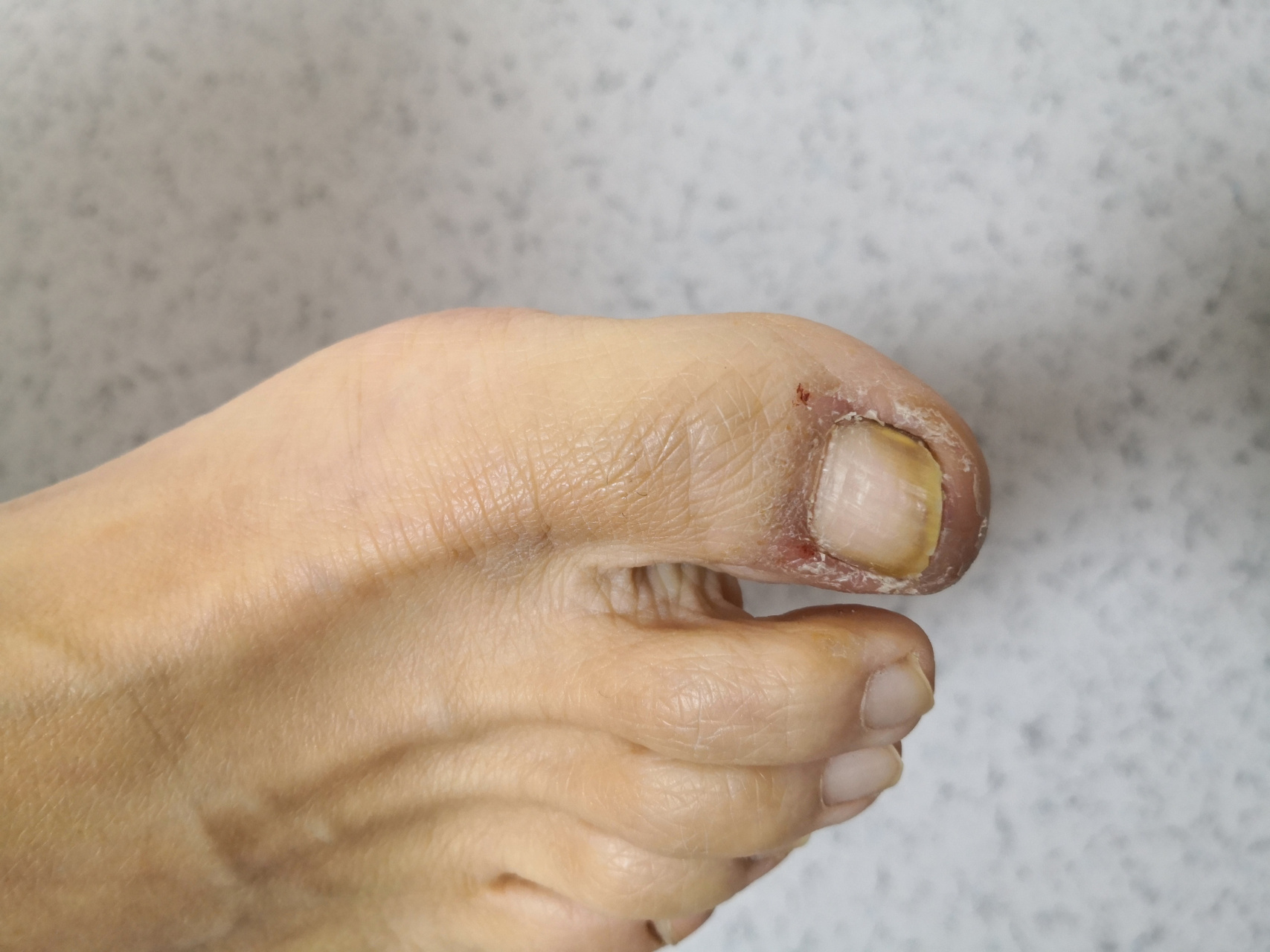 考虑灰指甲/甲癣症状.#解决皮肤问题专注皮肤美容##真菌