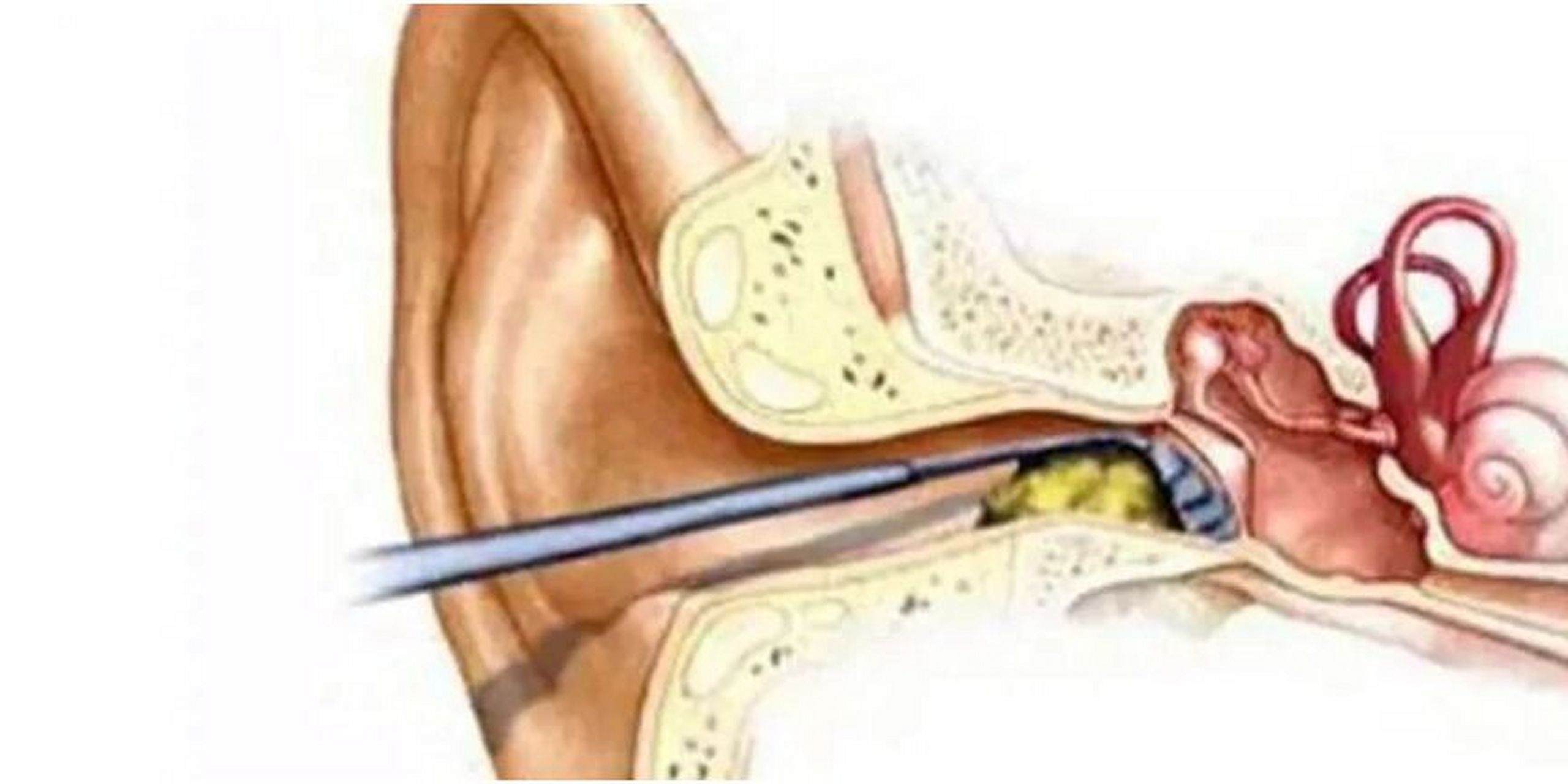 耵聍栓塞是引起耳堵,耳闷的最大元凶 耵聍栓塞是由于耵聍,也就是我们
