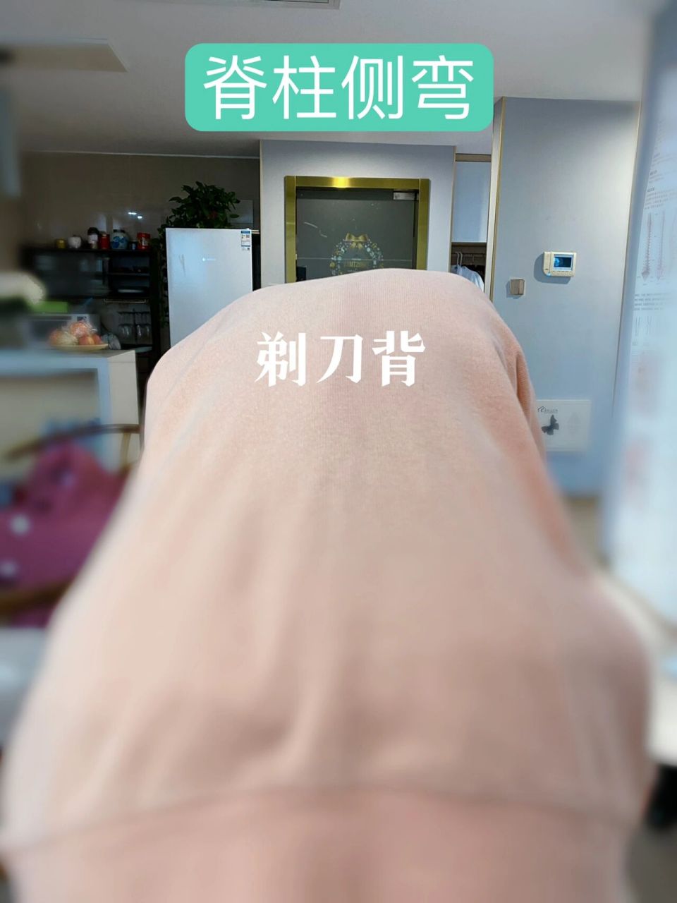 剃刀背 今天有接一位脊柱侧弯孩子,剃刀背非常明显