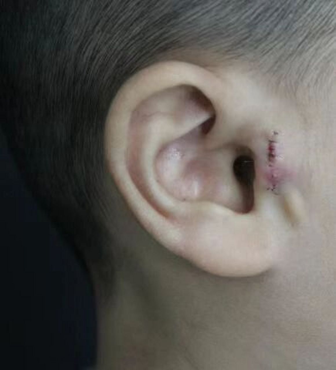 张正文教授# #张正文耳再造# #耳再造# #小耳畸形