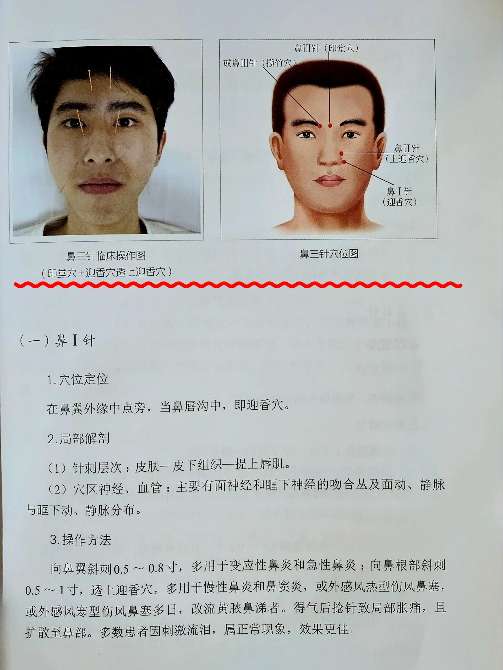 一个简易针灸鼻炎方,用力按压按亦可取消