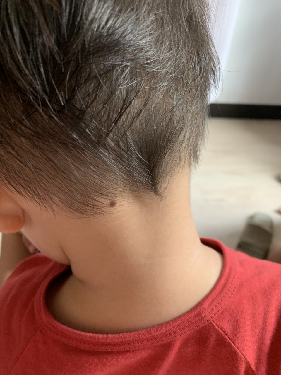 宝宝后颈黑痣 我一直以为长痣是很普遍的一个现象,直到下午看到小红书