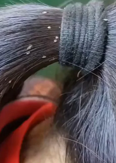 时,最有效的办法是剃光头发