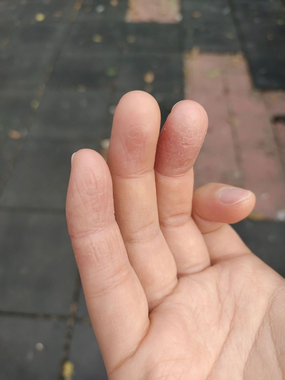 手指开裂啥原因啊? 有没有姐妹也这样啊?