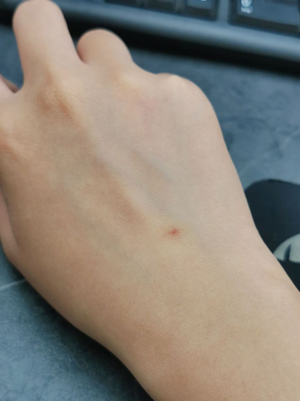 大概是高中上课无聊玩手指发现手背有个不痛不痒的小红点,到现在一