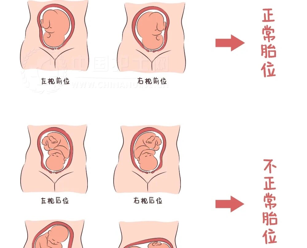 枕后位?还能自己生吗