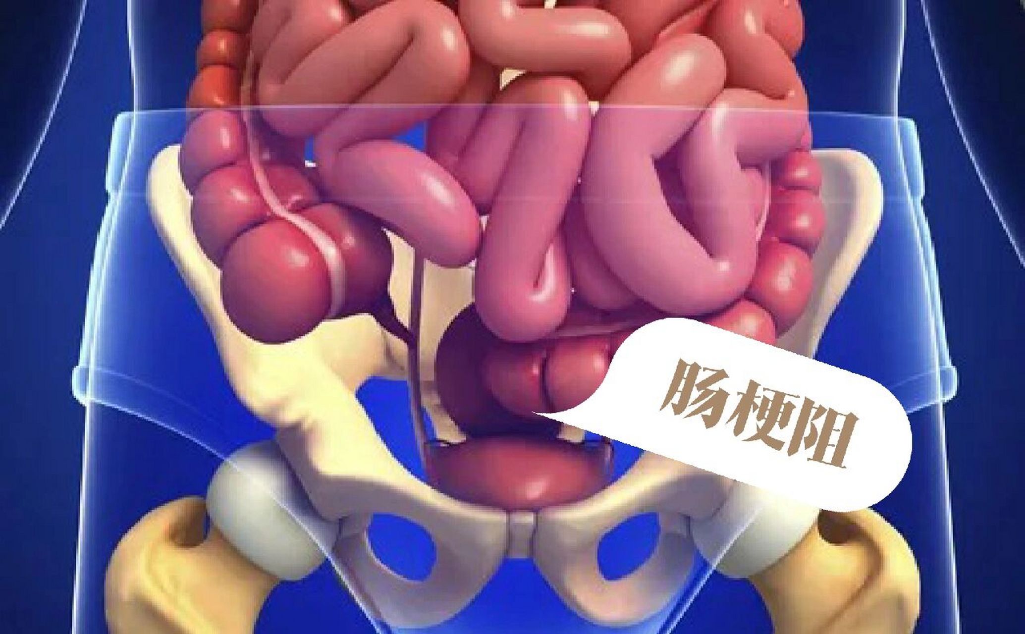 肠梗阻的症状是腹痛,呕吐,腹胀和肛门停止排便排气. 腹痛为阵发疼痛.