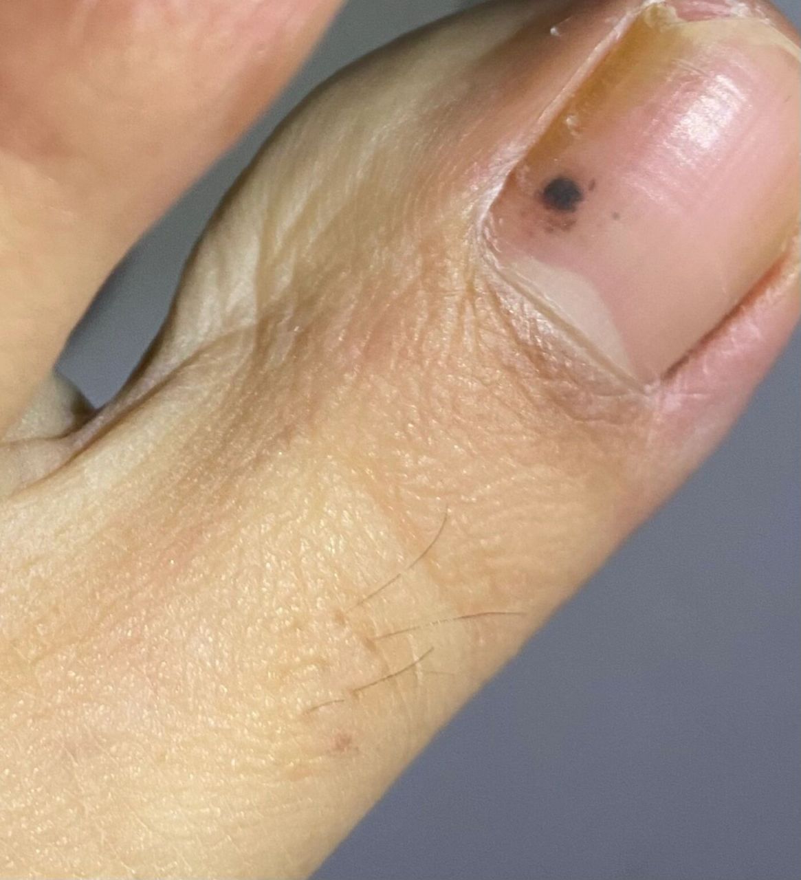指甲里面为啥莫名其妙的长了一个黑色的东西 妈呀这个是什么啊!