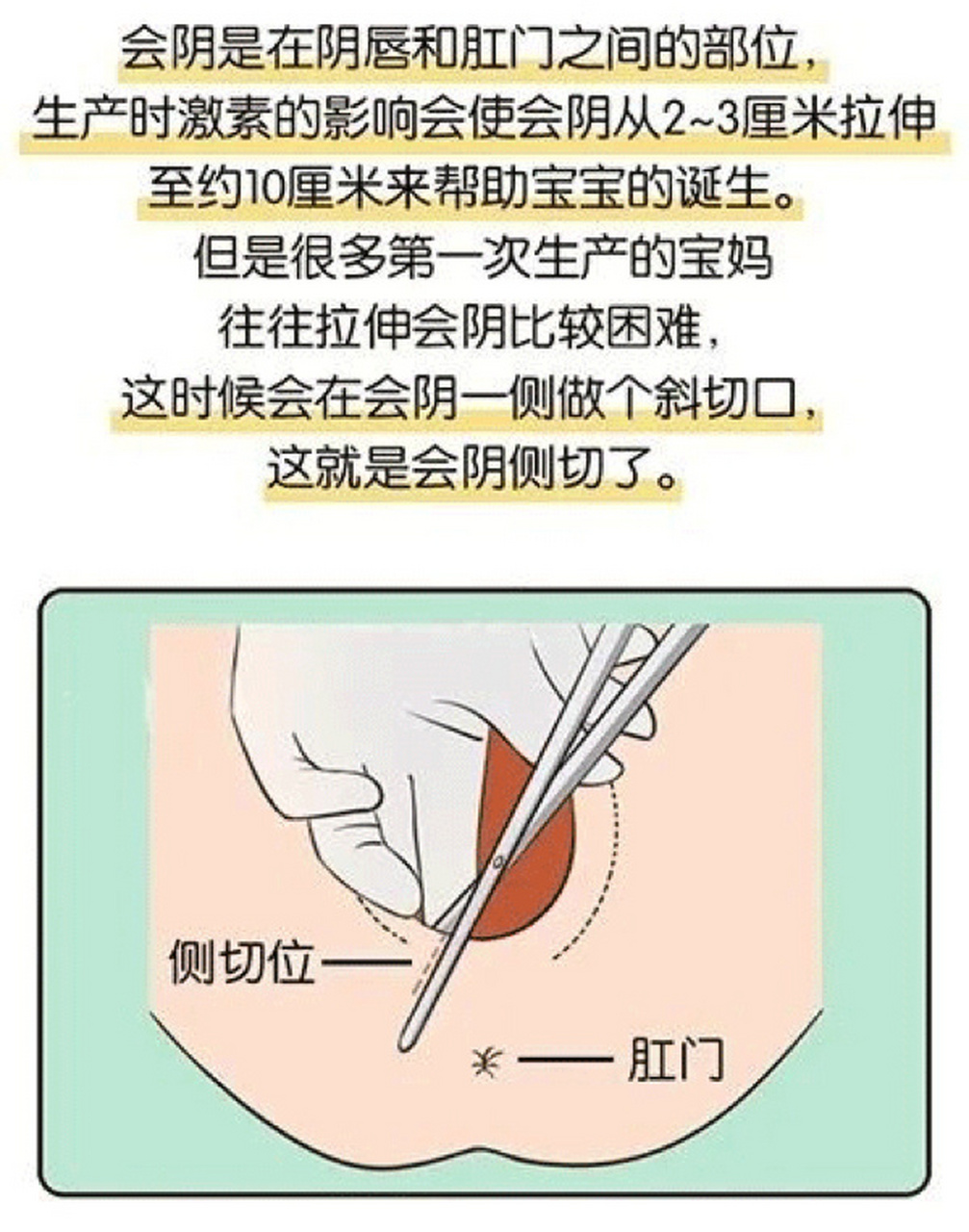 侧切在哪个位置图片图片