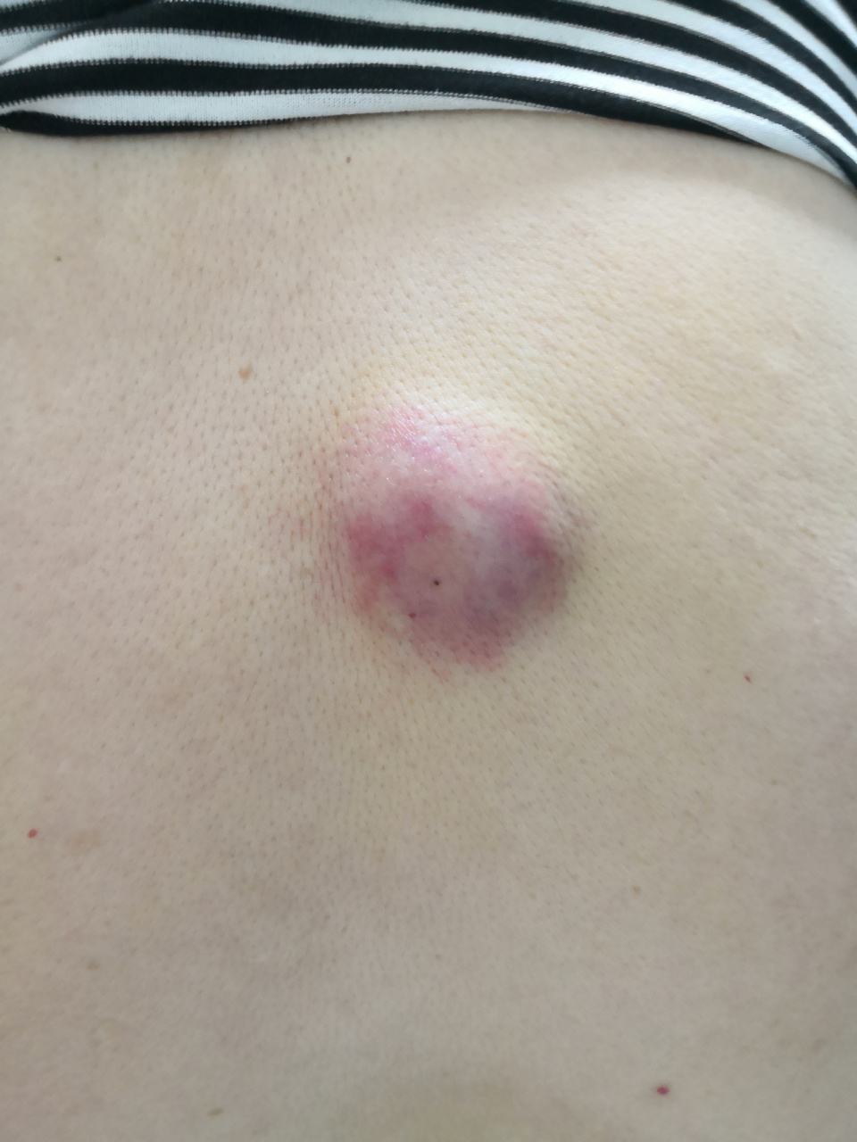 背部皮脂腺囊肿症状.