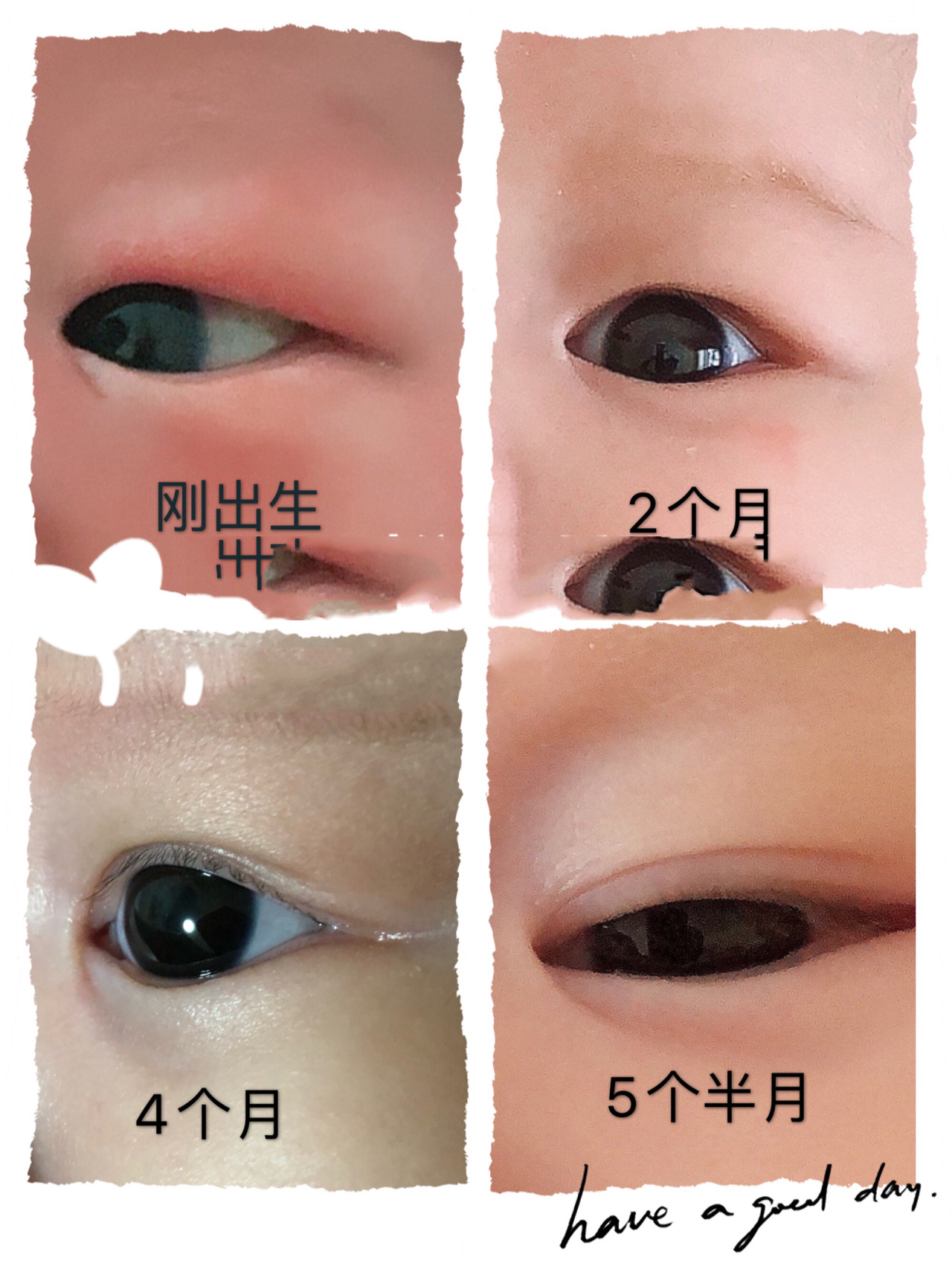 宝宝6个月的双眼皮进化史