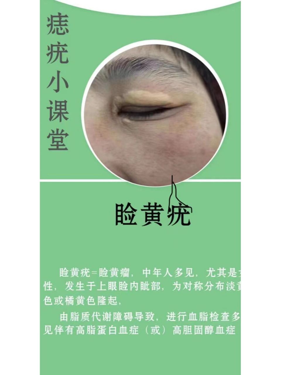 在上海哪院可以把睑黄疣去除吗,求指引