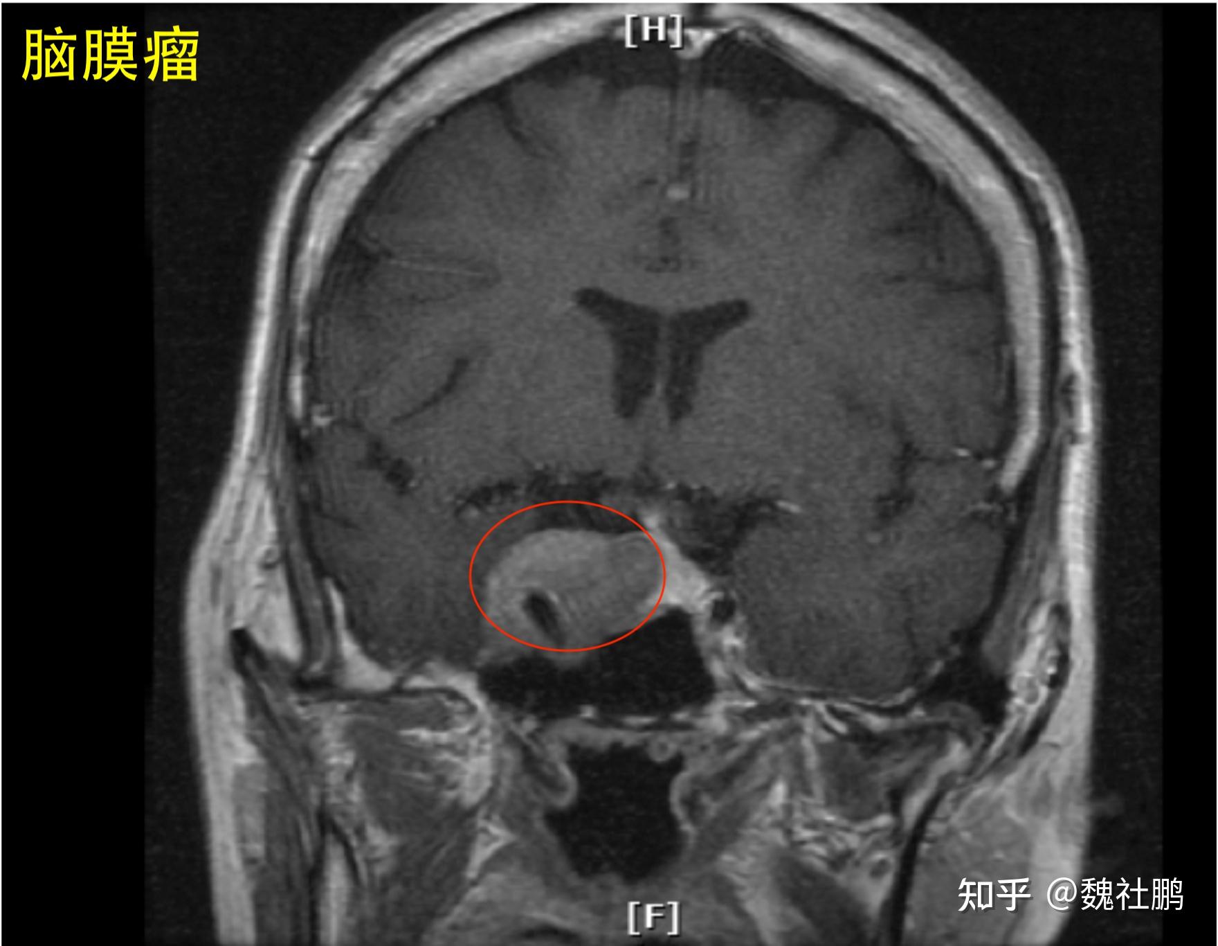 鞍区肿块的种类