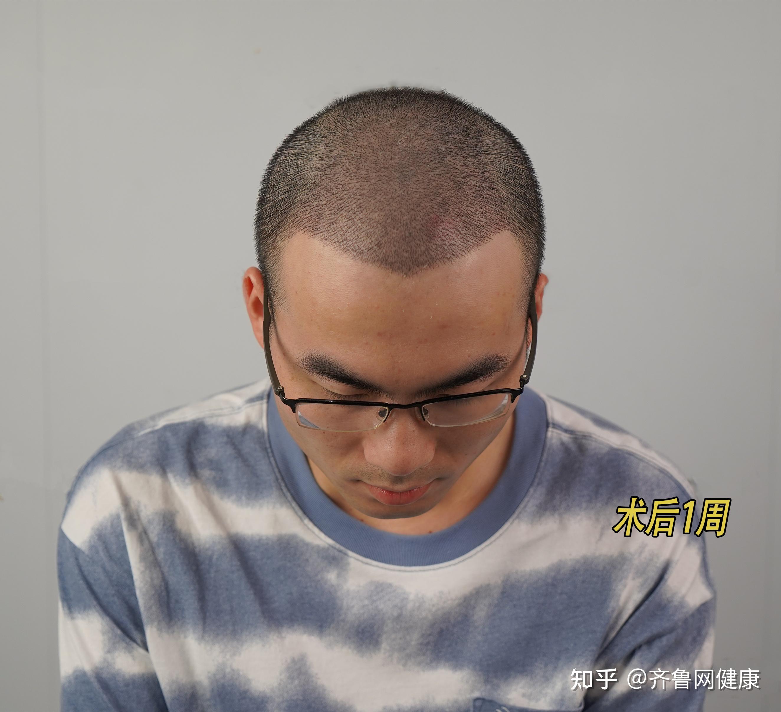 成都植发骗局(成都植发吧 百度贴吧)