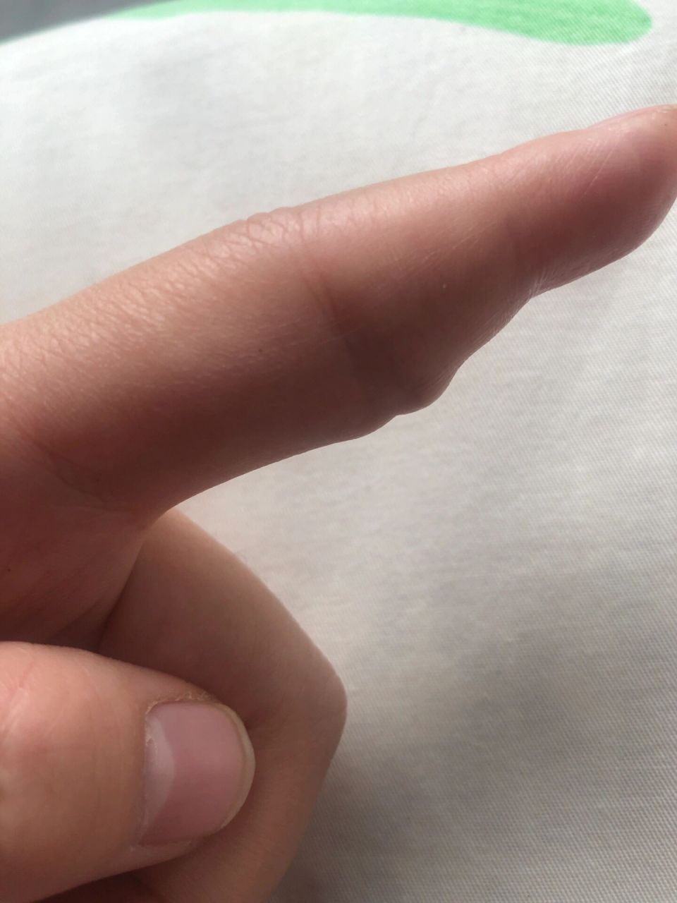 腱鞘巨细胞瘤手术才半年又复发了 手术半年 积水潭医院手外王医生做的