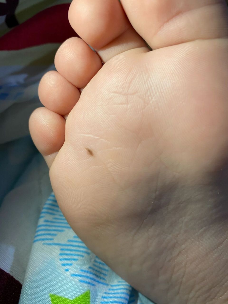 脚上痣 我们家孩子快六岁了,最近经常看到有痣要祛除,无意间发现孩子