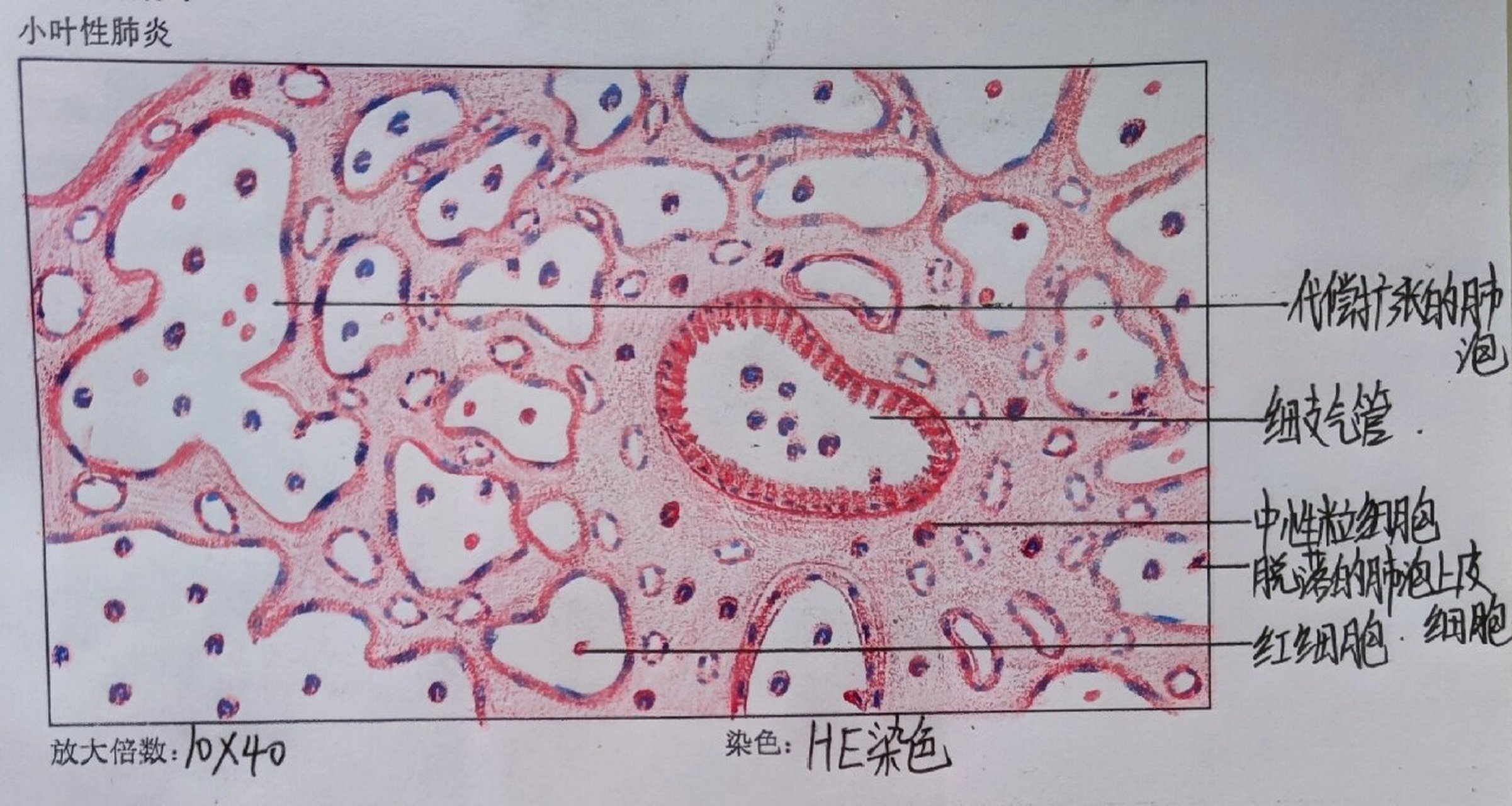 7215病理学红蓝铅笔第二弹 16615小叶性肺炎 95实变病灶内