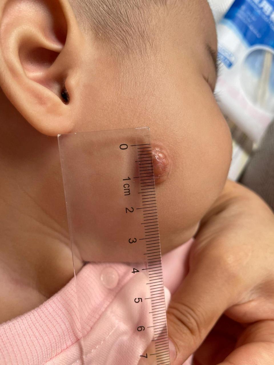 幼儿黄色肉芽肿 一个半月突发了一个小豆,最开始以为是蚊子咬的,早起