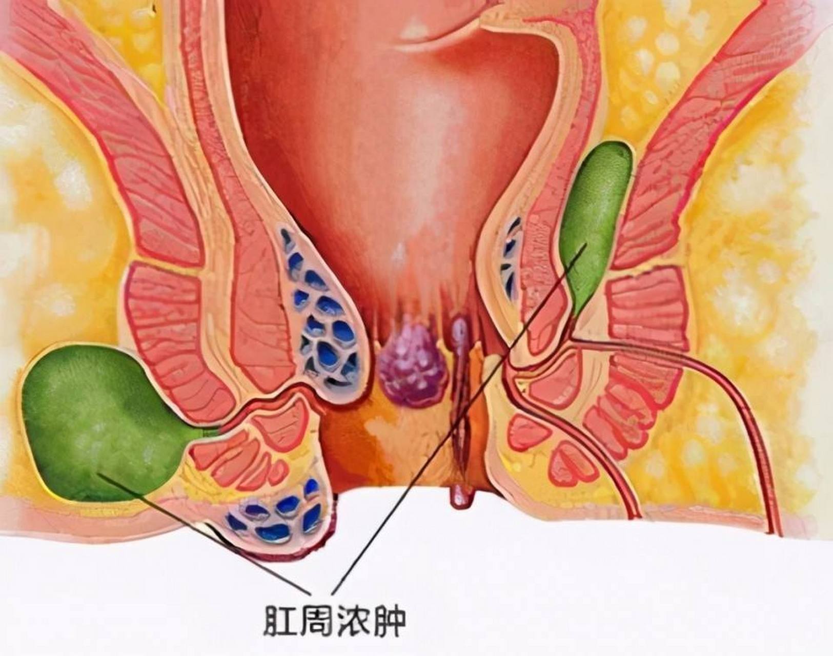 肛管直肠周围脓肿图片