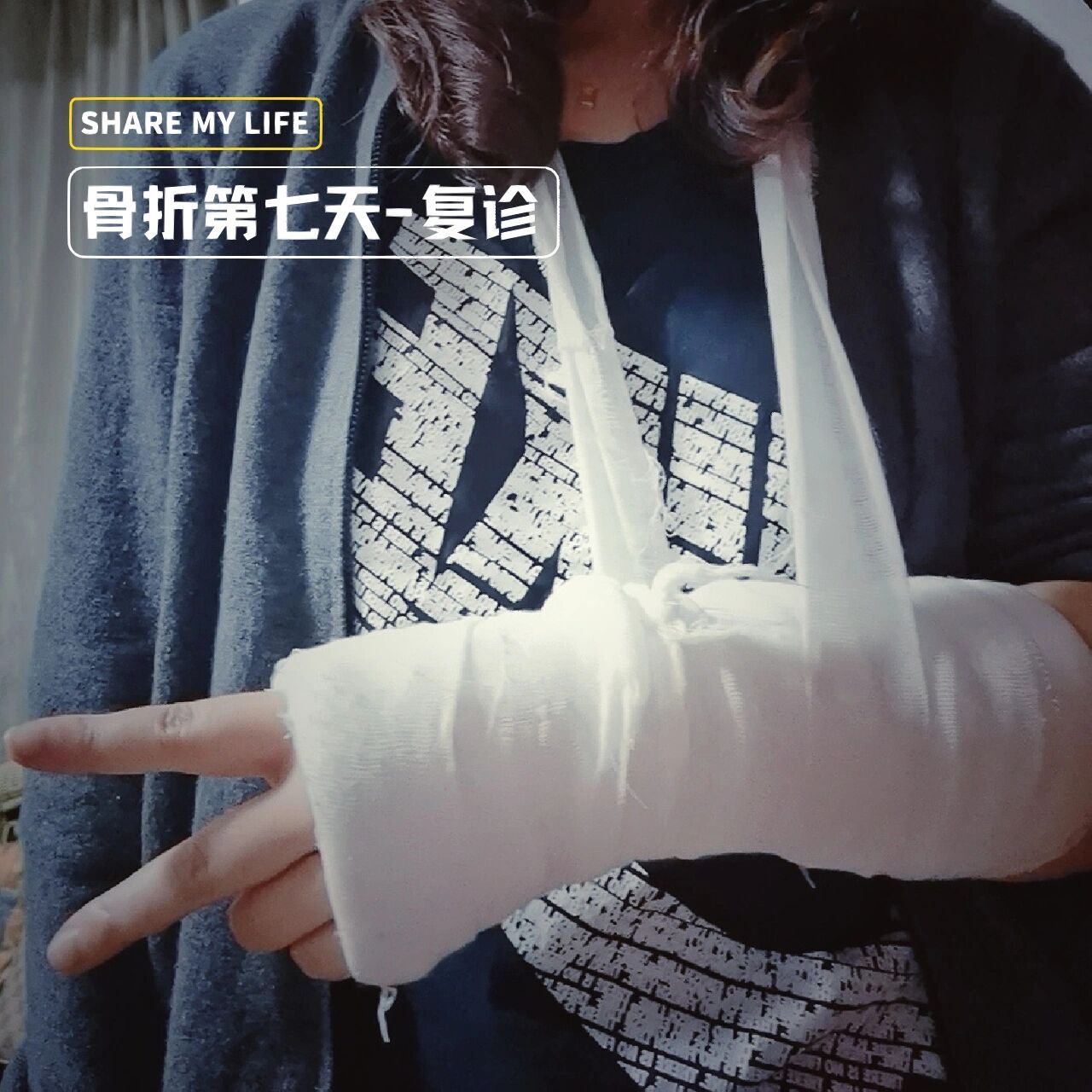 骨折day7 -复诊|右手尺桡骨远端骨折 今天是右手骨折的第7天了.