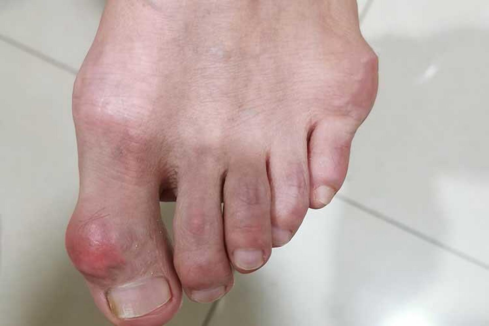 98大脚趾关节痛多是指大脚趾内关节或大脚趾与脚掌连接处的关节痛.