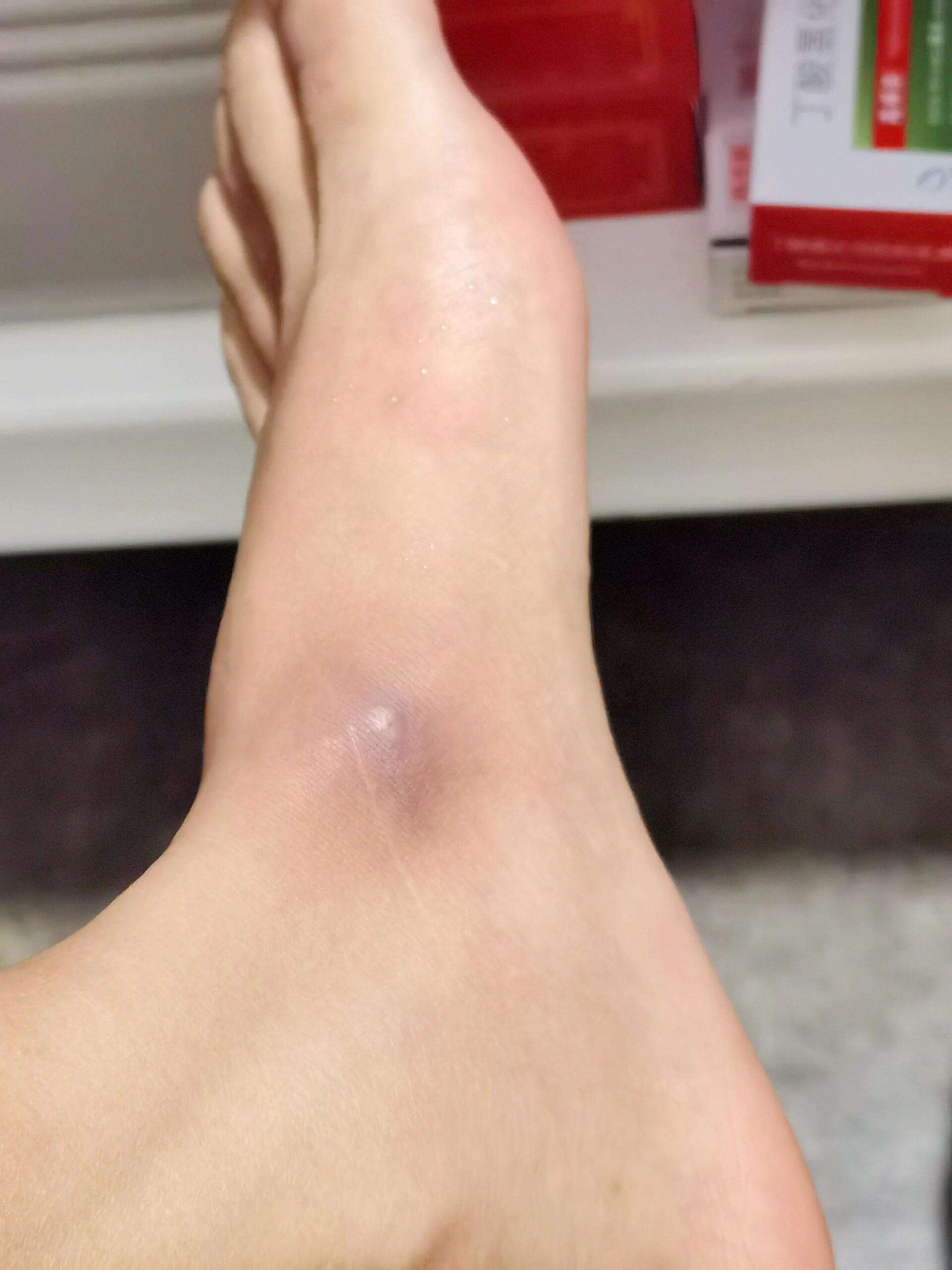 被蚂蚁咬第11天,这个紫块还会不会消