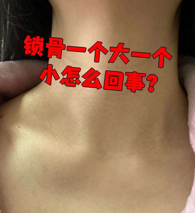 锁骨一个大一个小怎么回事?