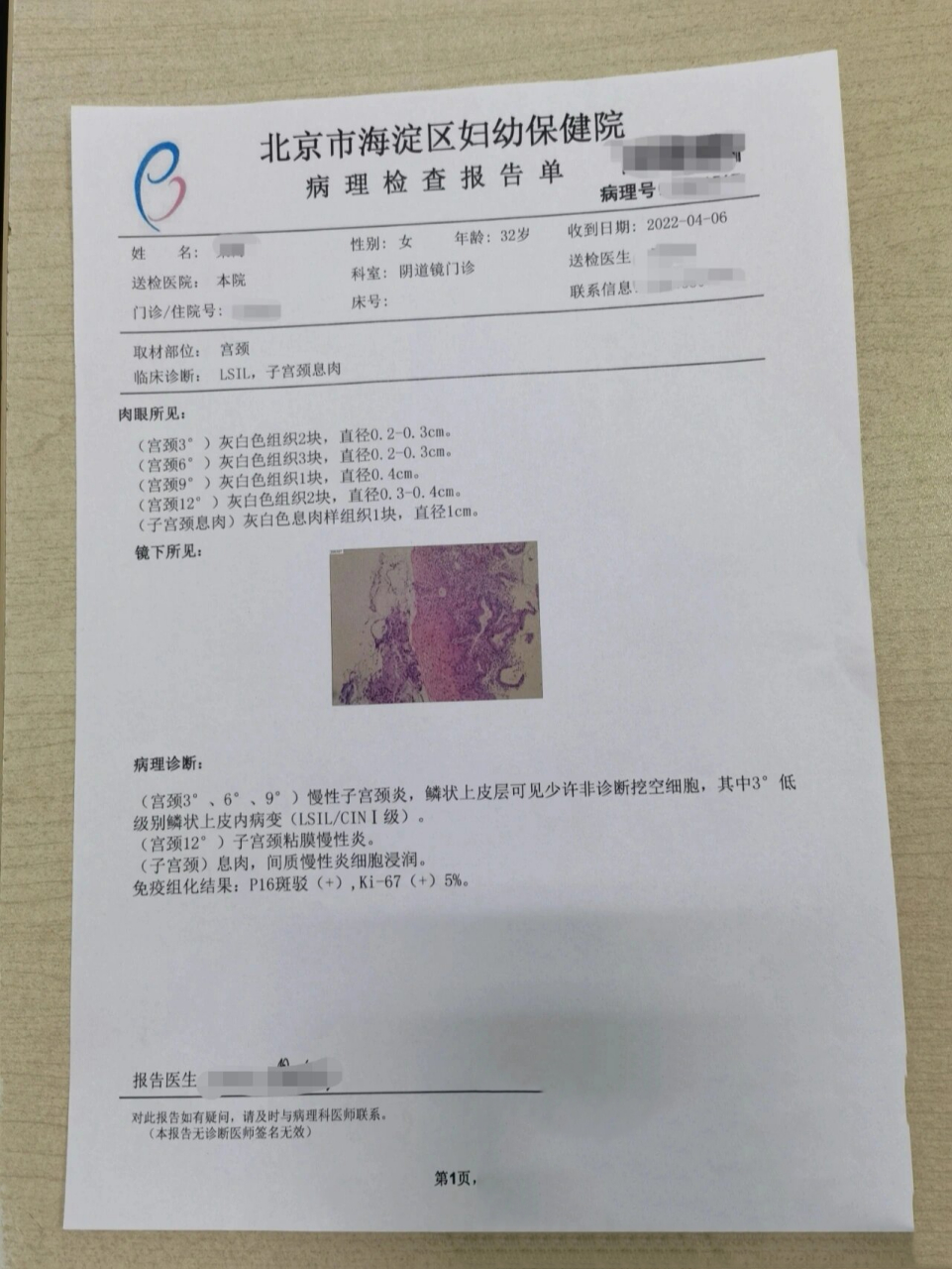 宫颈活检结果来了 一点lsil cin1三点炎症 接上篇,因为tct时候倍体