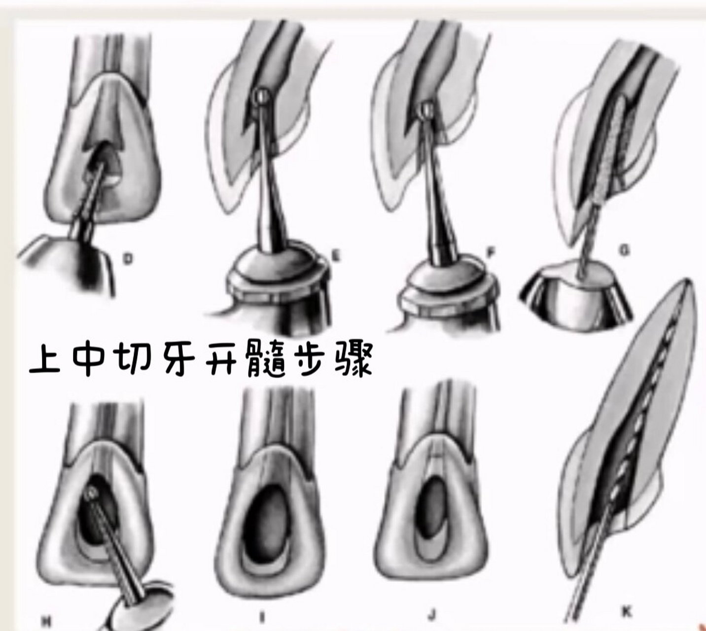 中切牙位置图片