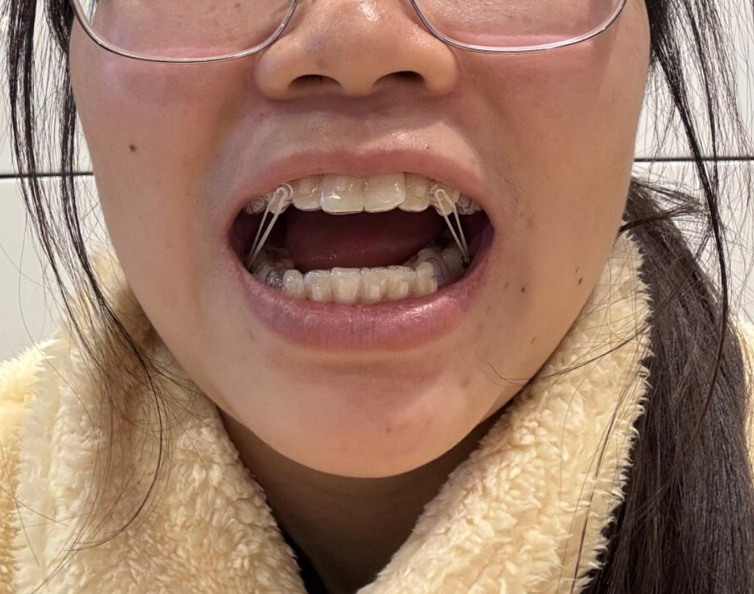 牙齿天包地是不是正常要看具体情况