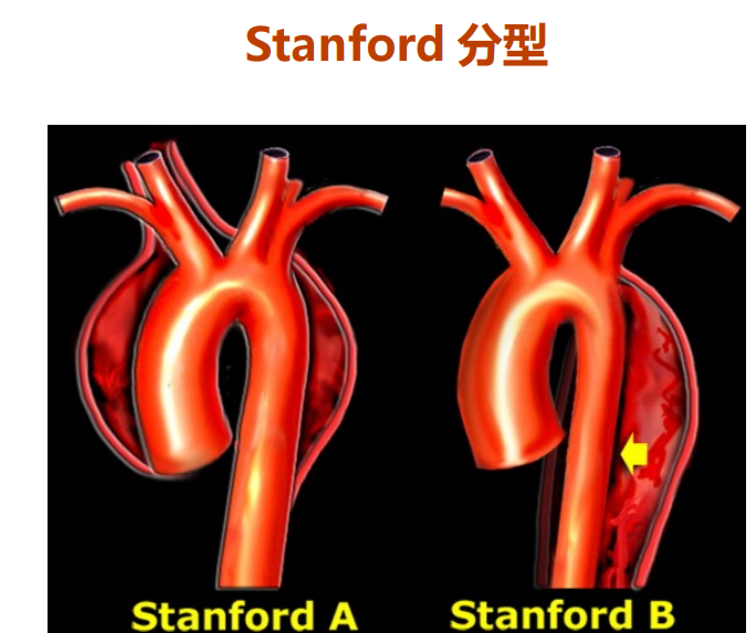 stanford分型图片