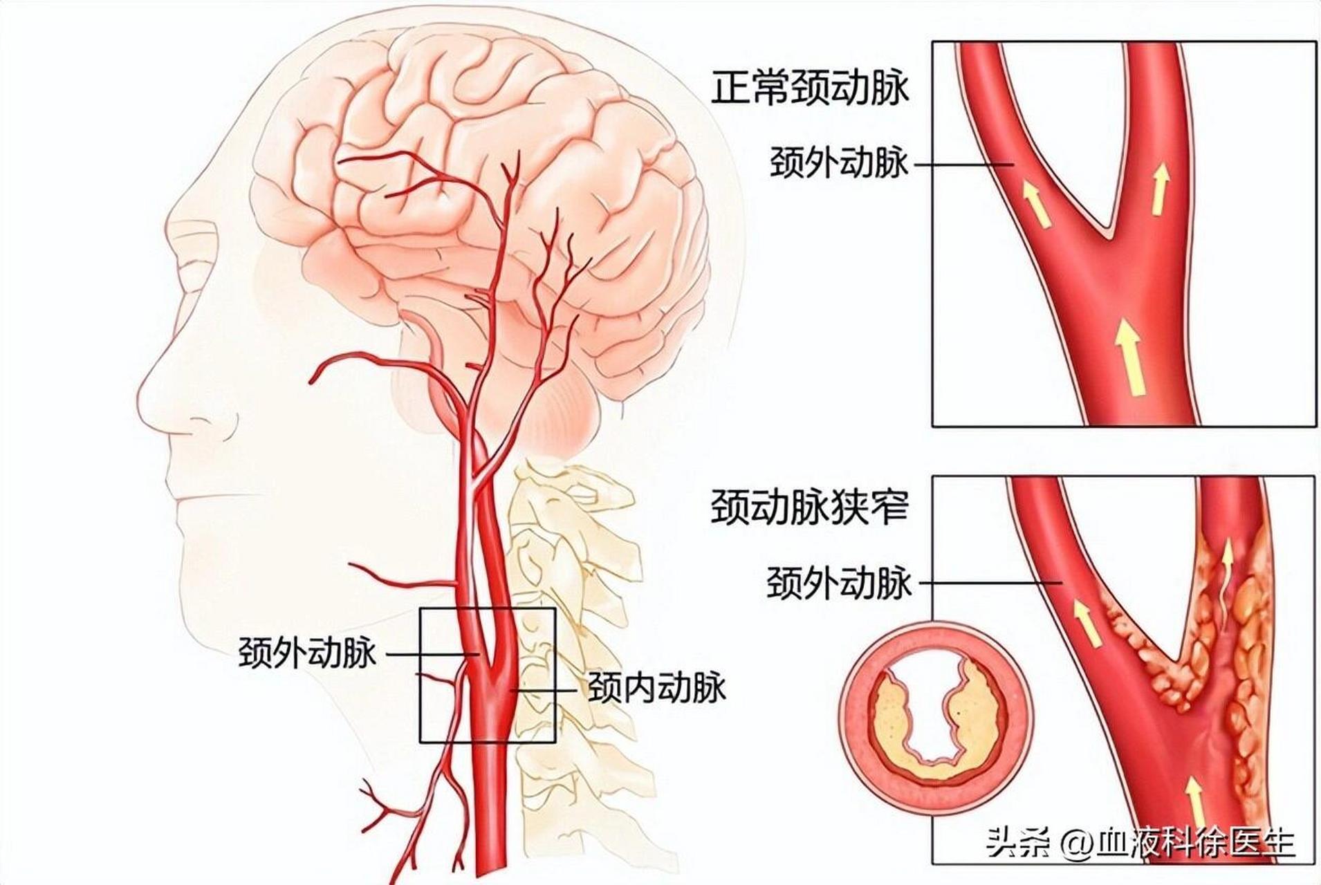 颈部血管凸起图片